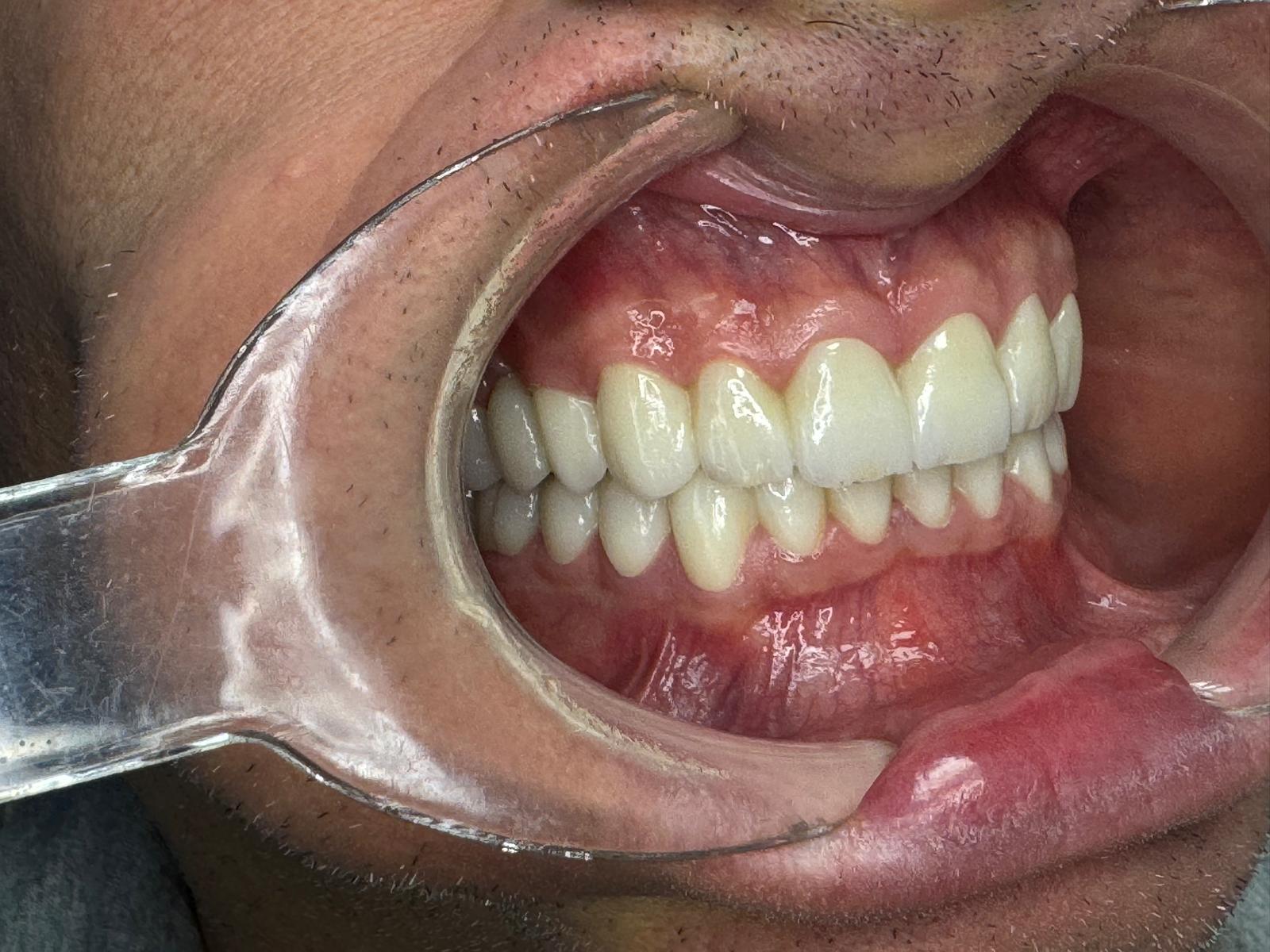 Vista lateral izquierda coronas — Gnadent