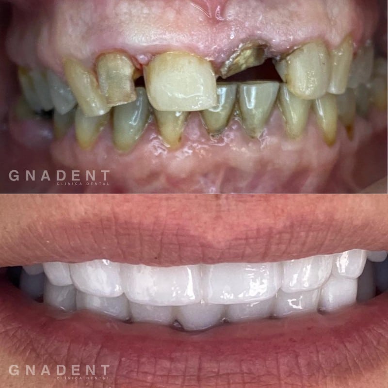 Método Digital Gnadent