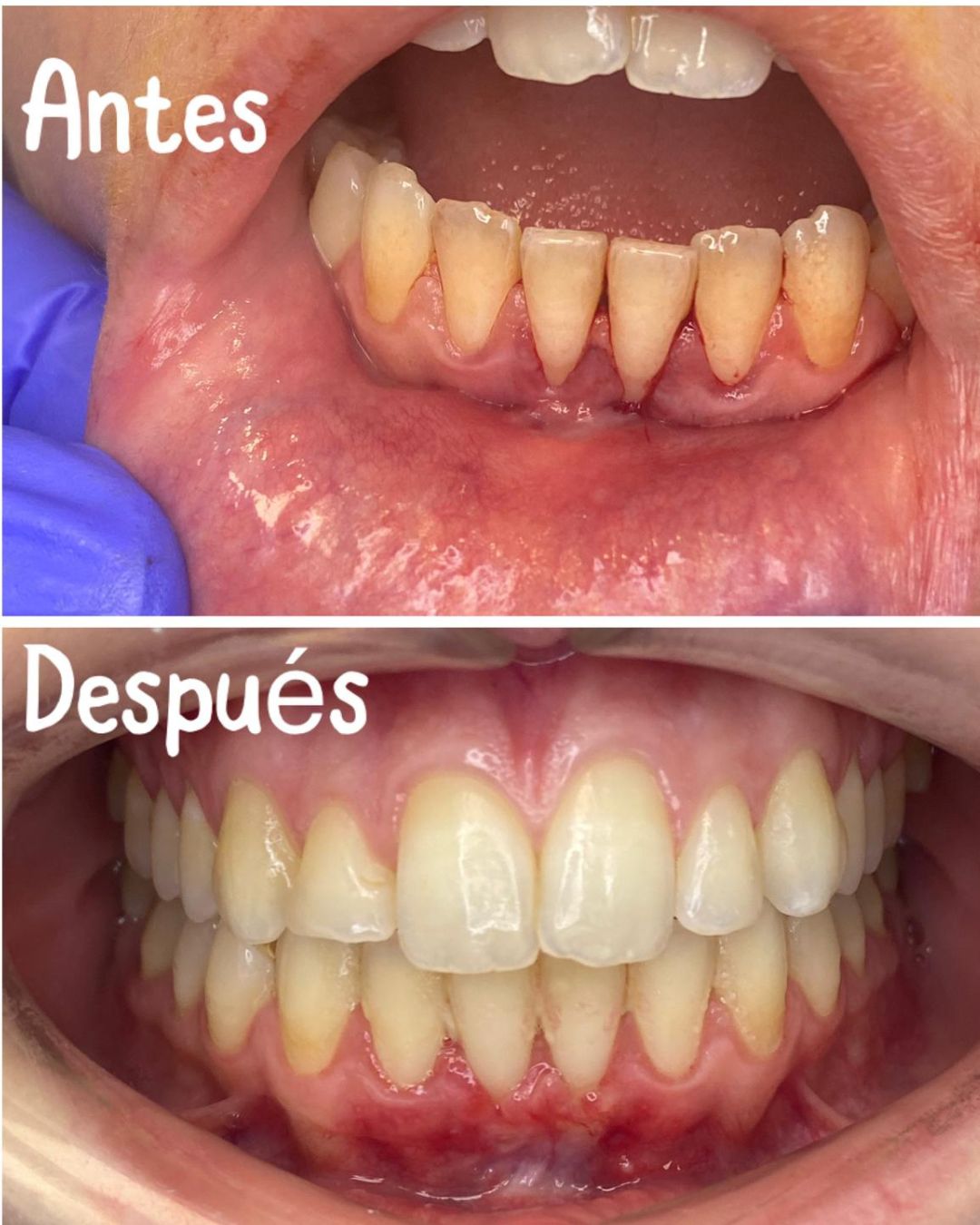 Caso Real Gnadent 1 — Antes y Después