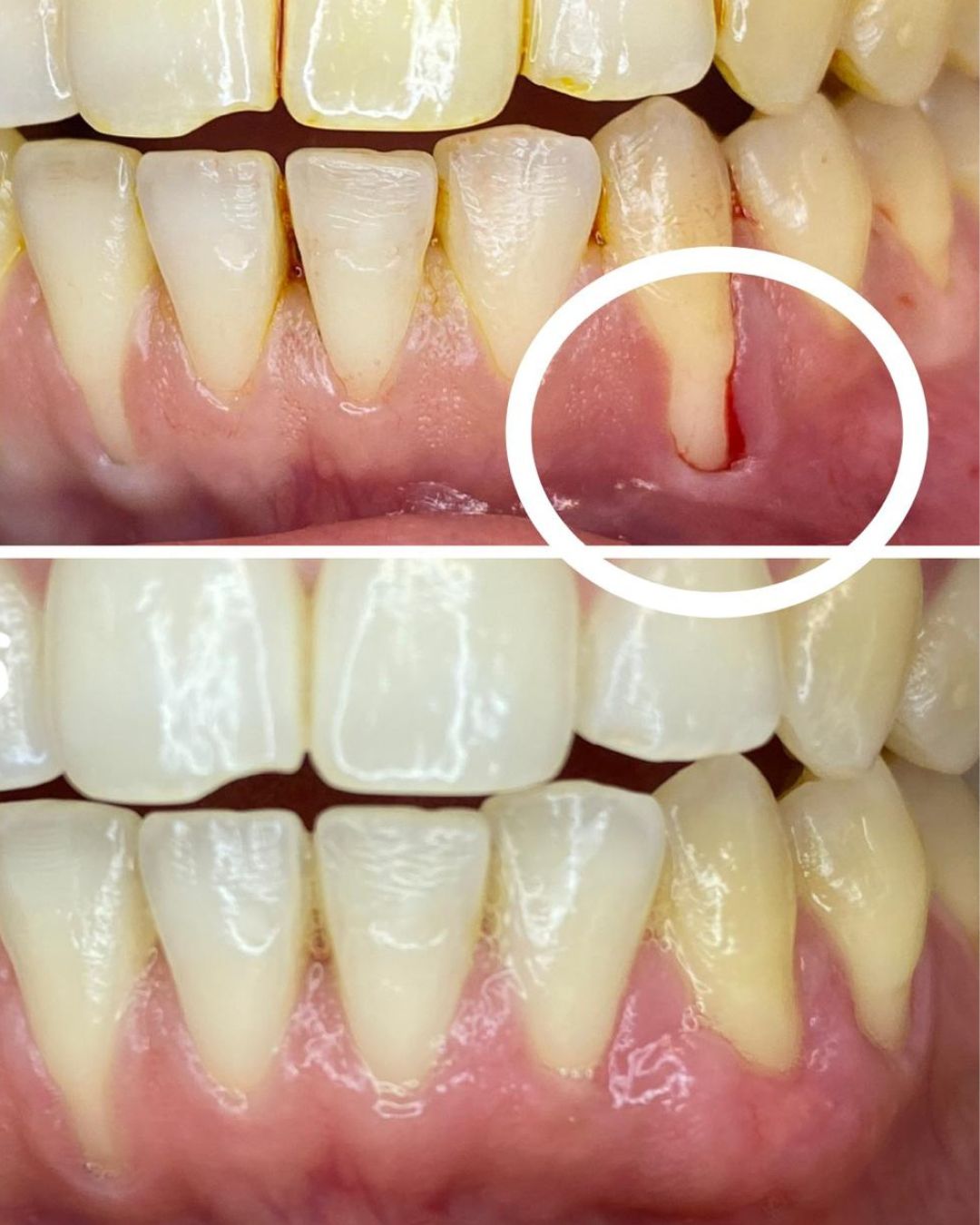 Caso Real Gnadent 2 — Antes y Después