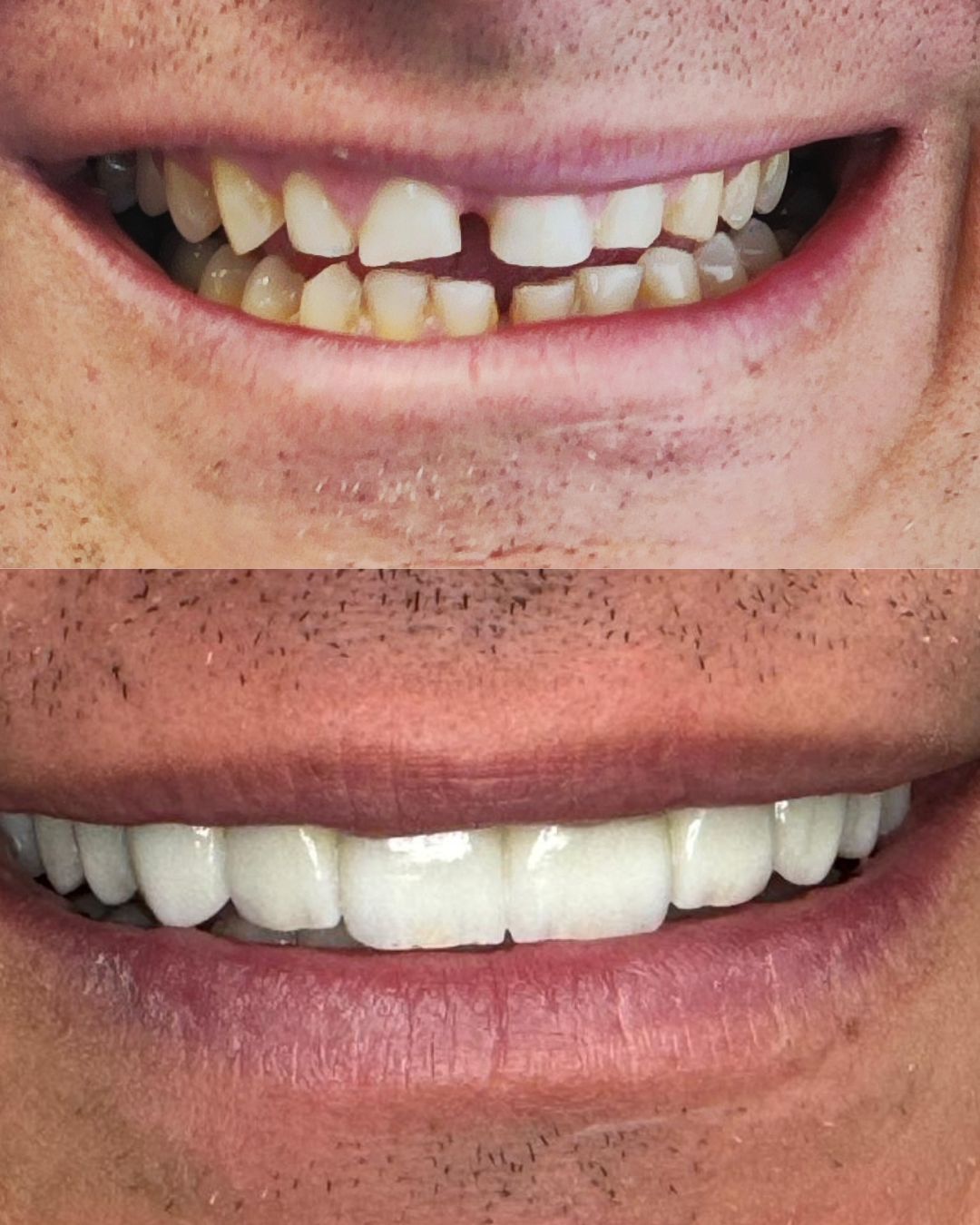 Caso Real Gnadent 3 — Antes y Después