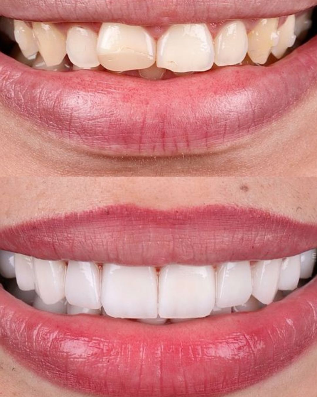 Caso Real Gnadent 4 — Antes y Después