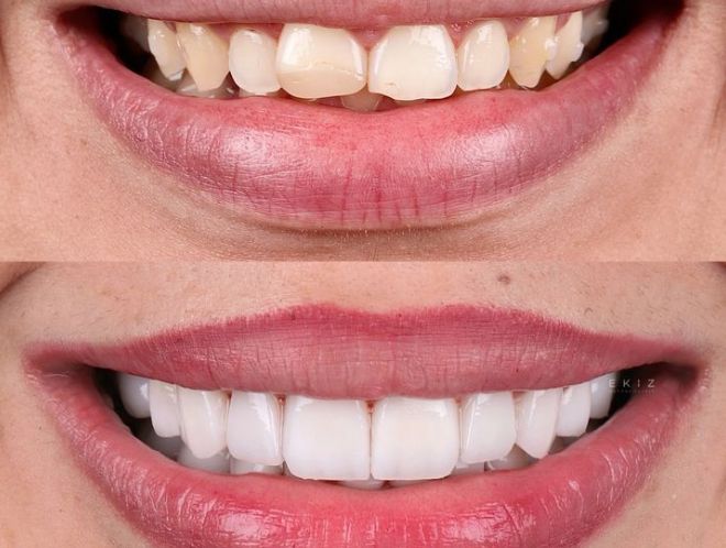 Caso Real de Carillas Dentales Gnadent Valencia — Antes y Después