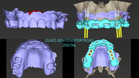 Escáner Intraoral 3D