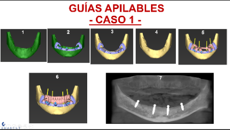 Guía Quirúrgica Impresa en 3D